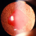 Secondary cataract after YAG