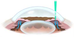 yag iridotomy